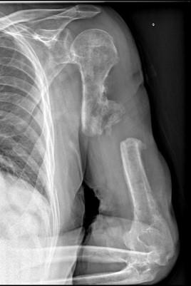 exemple de pseudoarthrose d'humérus à 10 mois