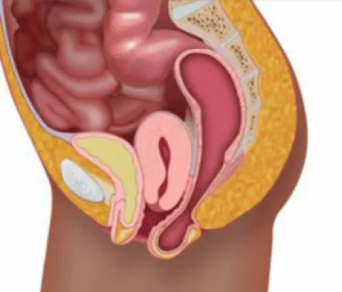 Pelvic statics diagram